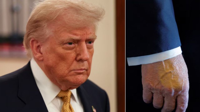 La Casa Blanca reveló que Trump sufre una «insuficiencia venosa crónica»: qué síntomas padece